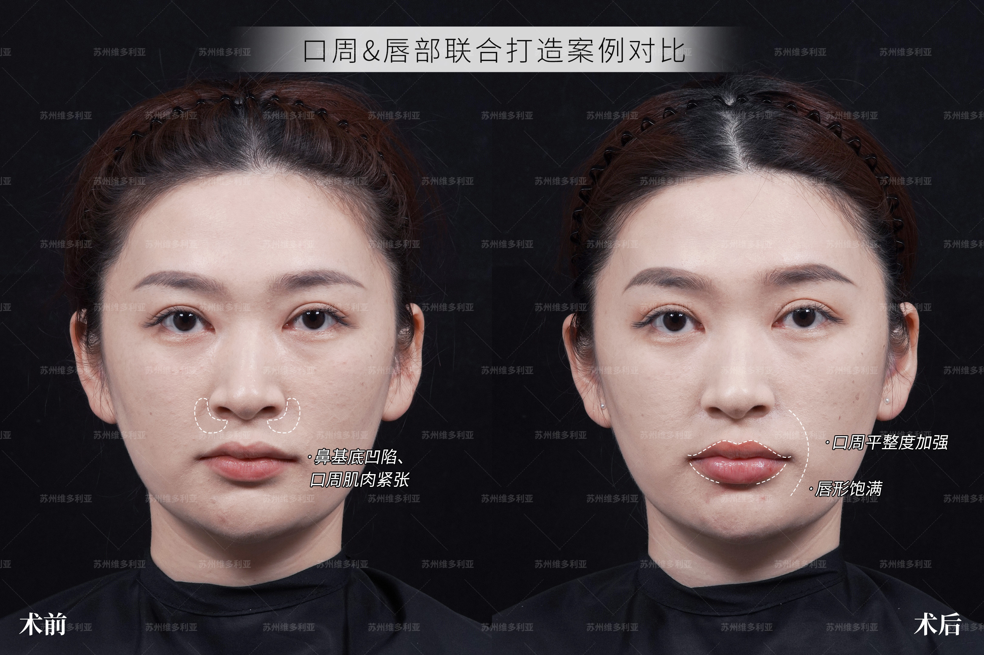 苏州双眼皮可选美贝尔_苏州吴中维多利亚美容医院双眼皮_维密Ultra美眼苏州