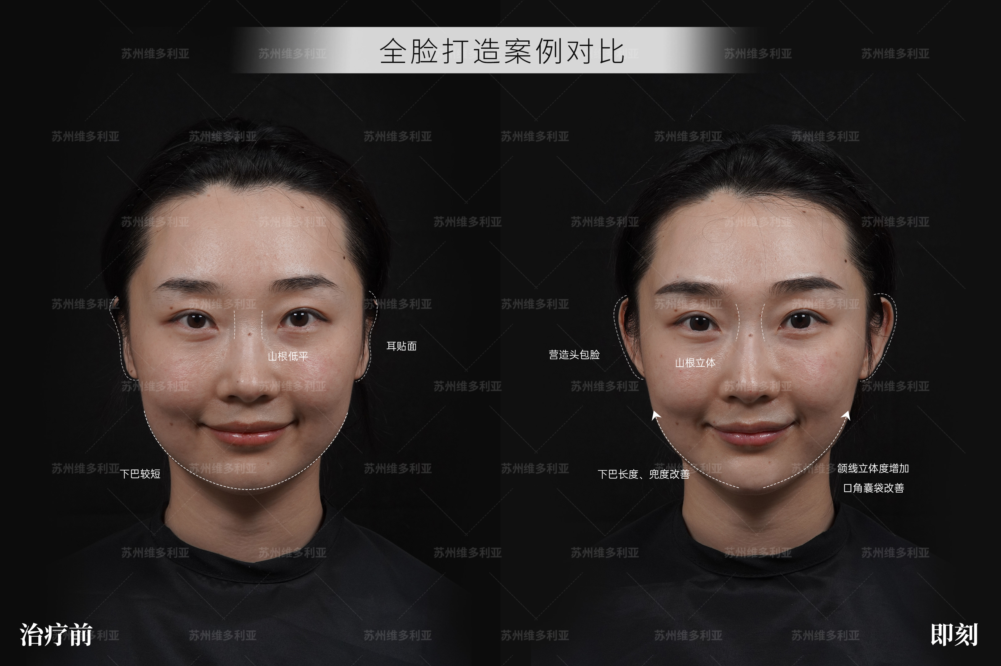 苏州双眼皮可选美贝尔_维密Ultra美眼苏州_苏州吴中维多利亚美容医院双眼皮